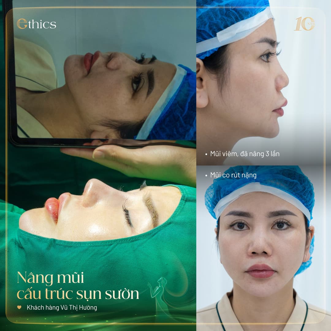 Rinoplastika s konstrukcí z vlastní chrupavky v Ethics Aesthetic Clinic