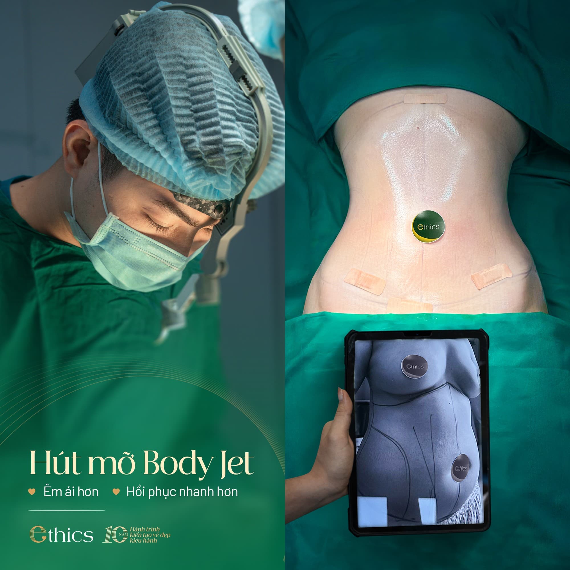 Liposukce Body Jet