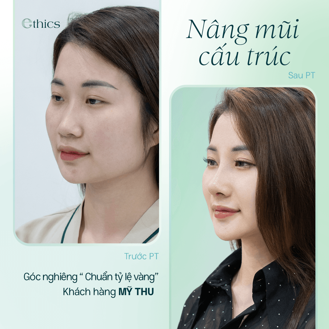 Strukturální rinoplastika - 10 dní pro nový vzhled